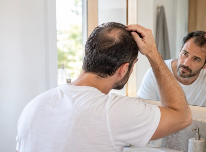 תמונה של גבר מקריח מסתכל על עצמו במראה
